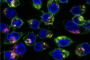 Microscope image of drugs binding to pancreatic cancer cells.