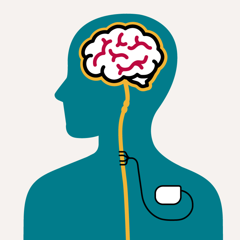 Illustration of the vagus nerve implant. Links to full story.