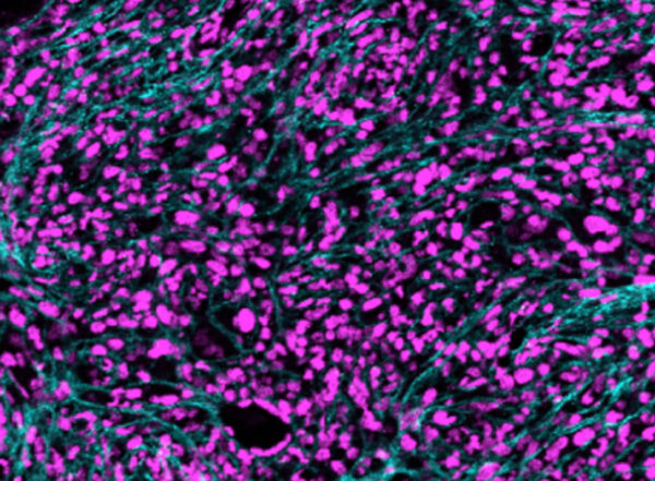 Bone marrow image showing a blood cancer.