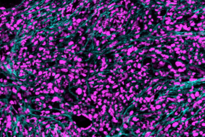 Bone marrow image showing a blood cancer.