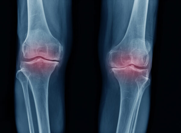 X-ray image of knees with inflammation