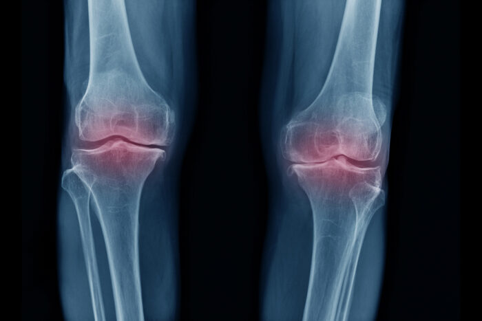 X-ray image of knees with inflammation
